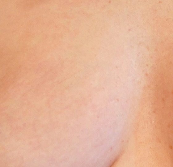 striae navel strakke huid striae behandeling na foto striae navel strakke huid striae behandeling na foto
