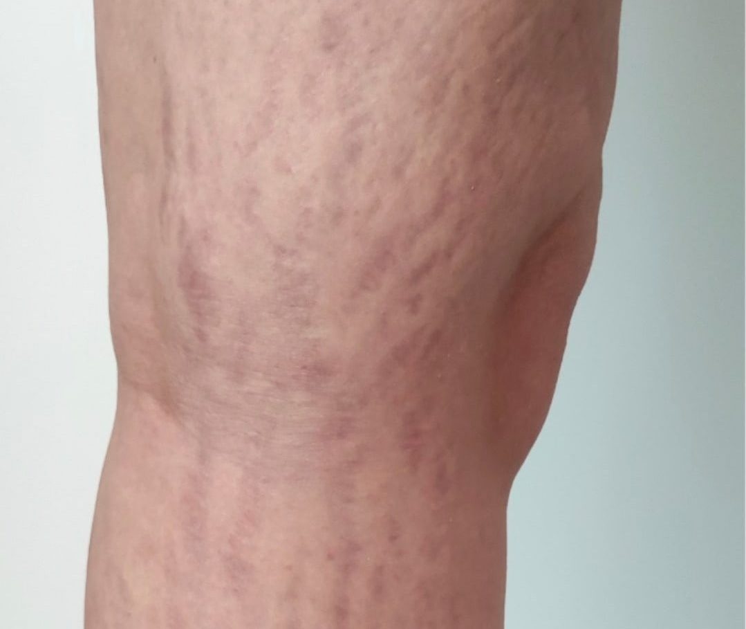 Striae behandeling been Striae behandeling been