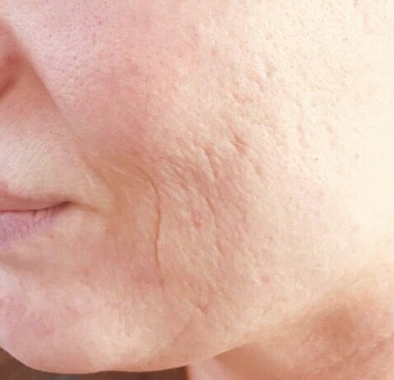 acne behandeling peeling voor foto