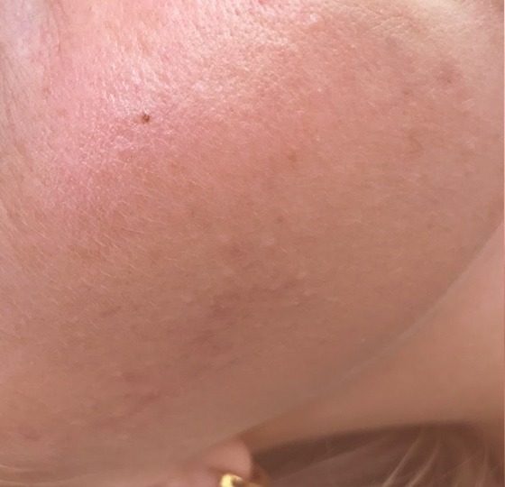 acne behandeling peeling na foto strakke huid acne behandeling peeling na foto strakke huid
