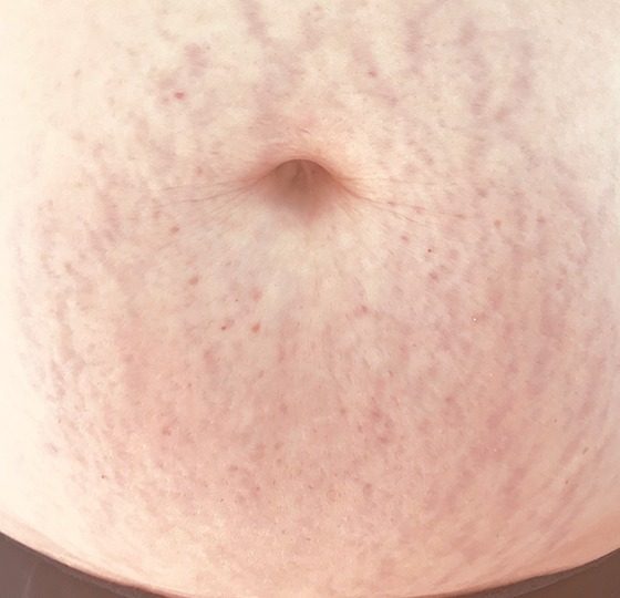 striae navel egale huid striae behandeling striae navel egale huid striae behandeling