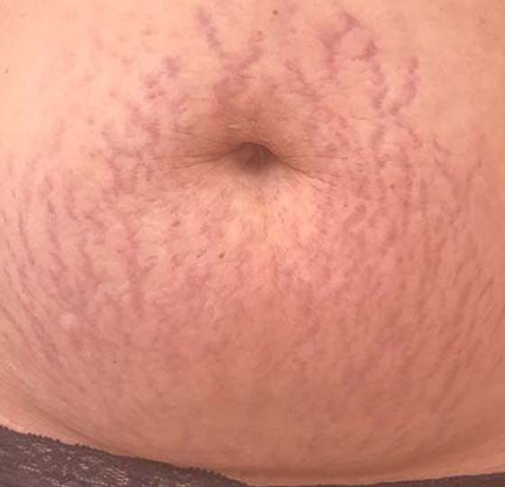 striae navel egale huid striae behandeling striae navel egale huid striae behandeling