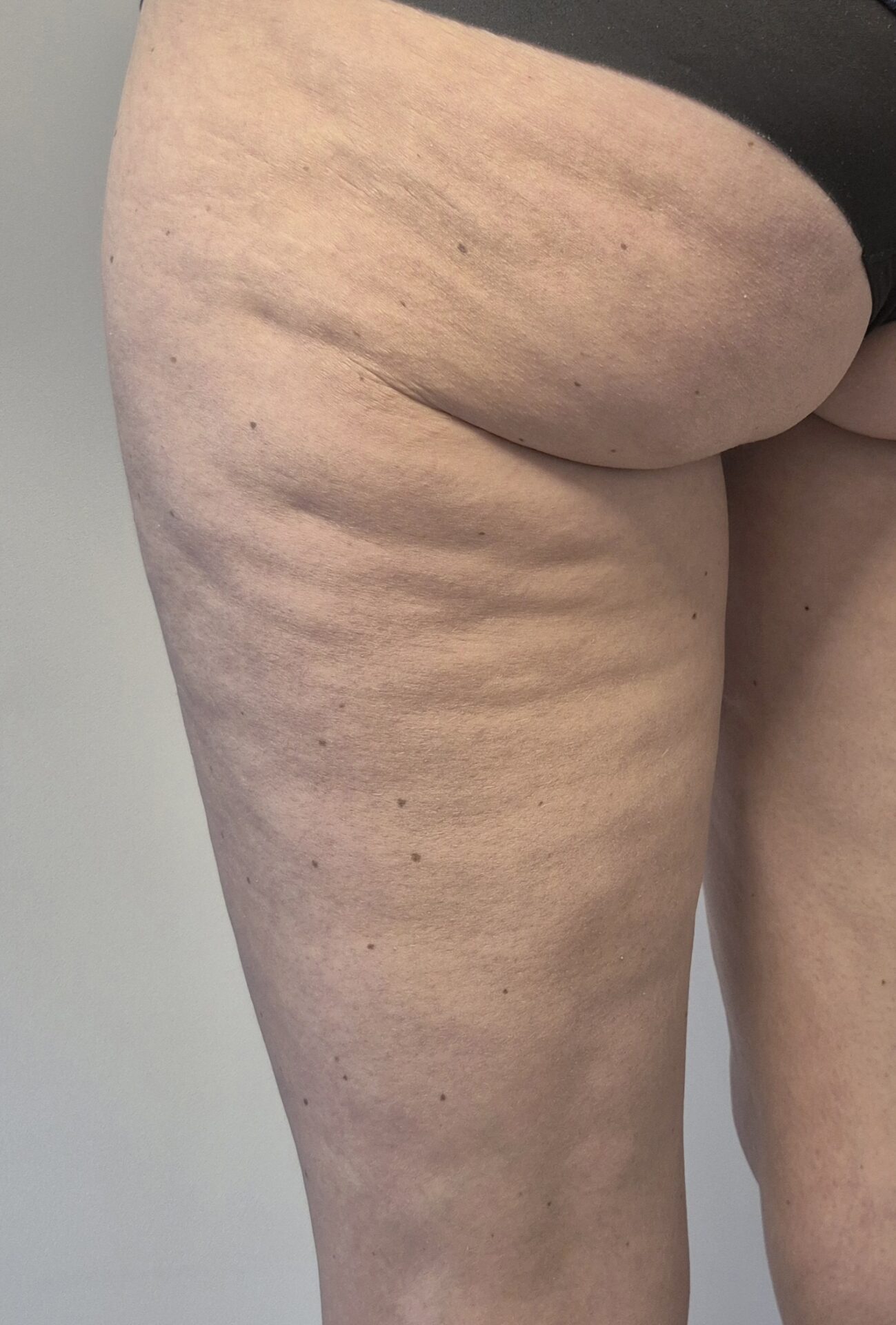 foto voorafgaand aan cellulite behandeling