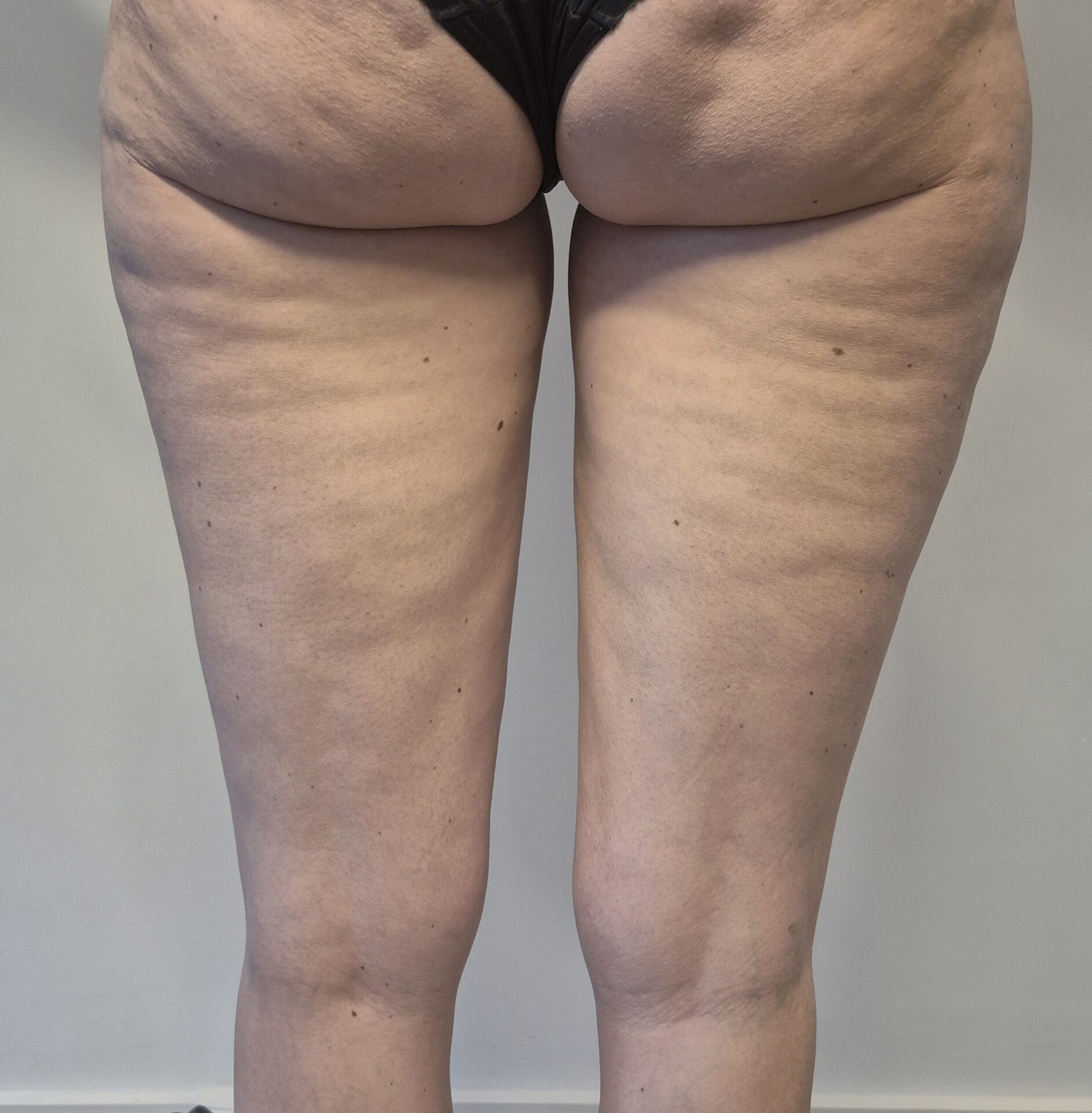 foto voorafgaand aan cellulite behandeling