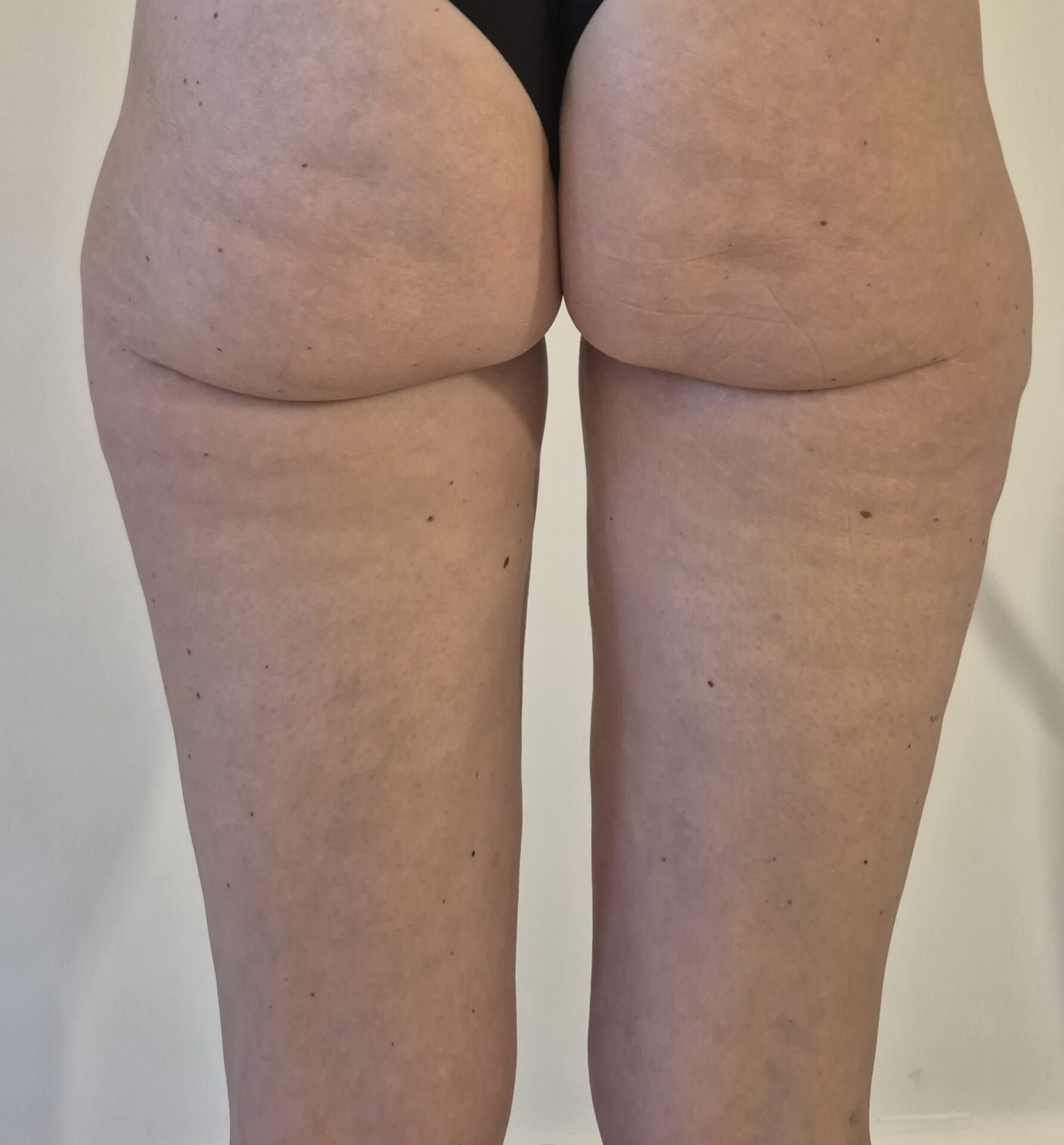 Resultaat celulite/cellulitis behandeling