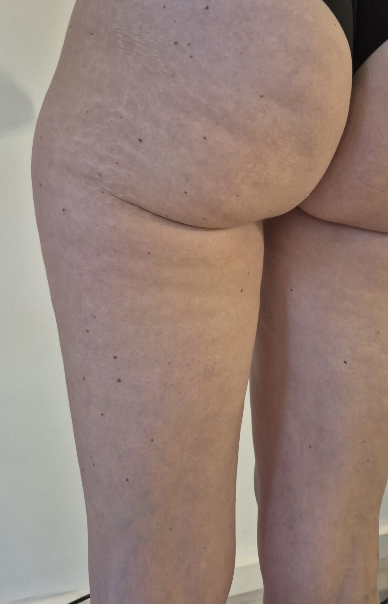 resultaat foto cellulite/cellulitis behandeling