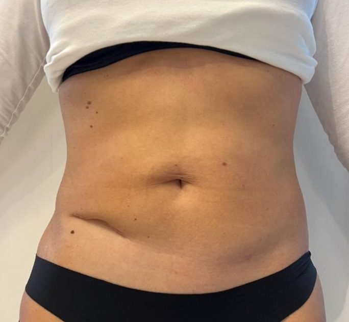 after foto cryolipolyse