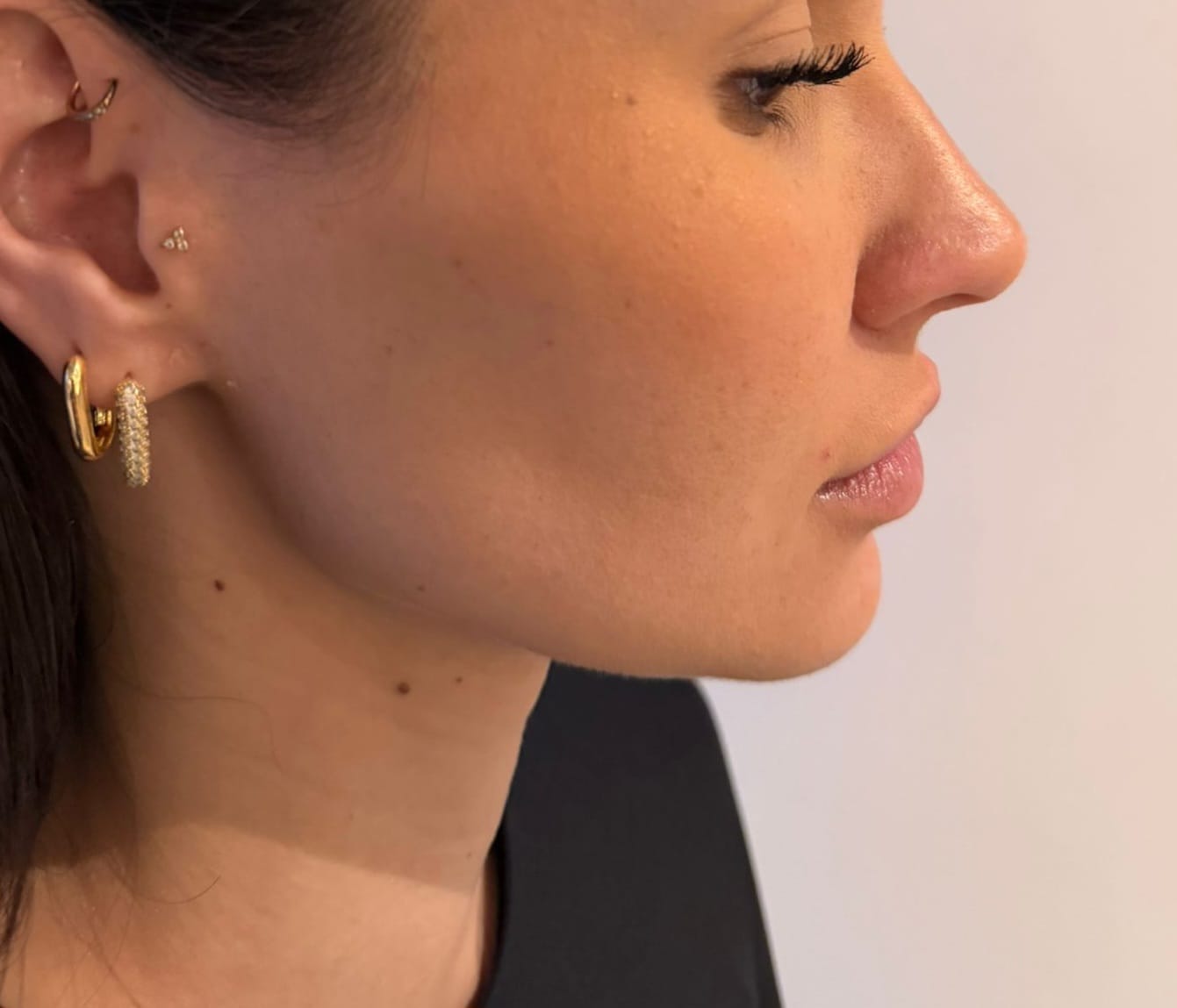 After foto HIFU kaaklijn behandeling