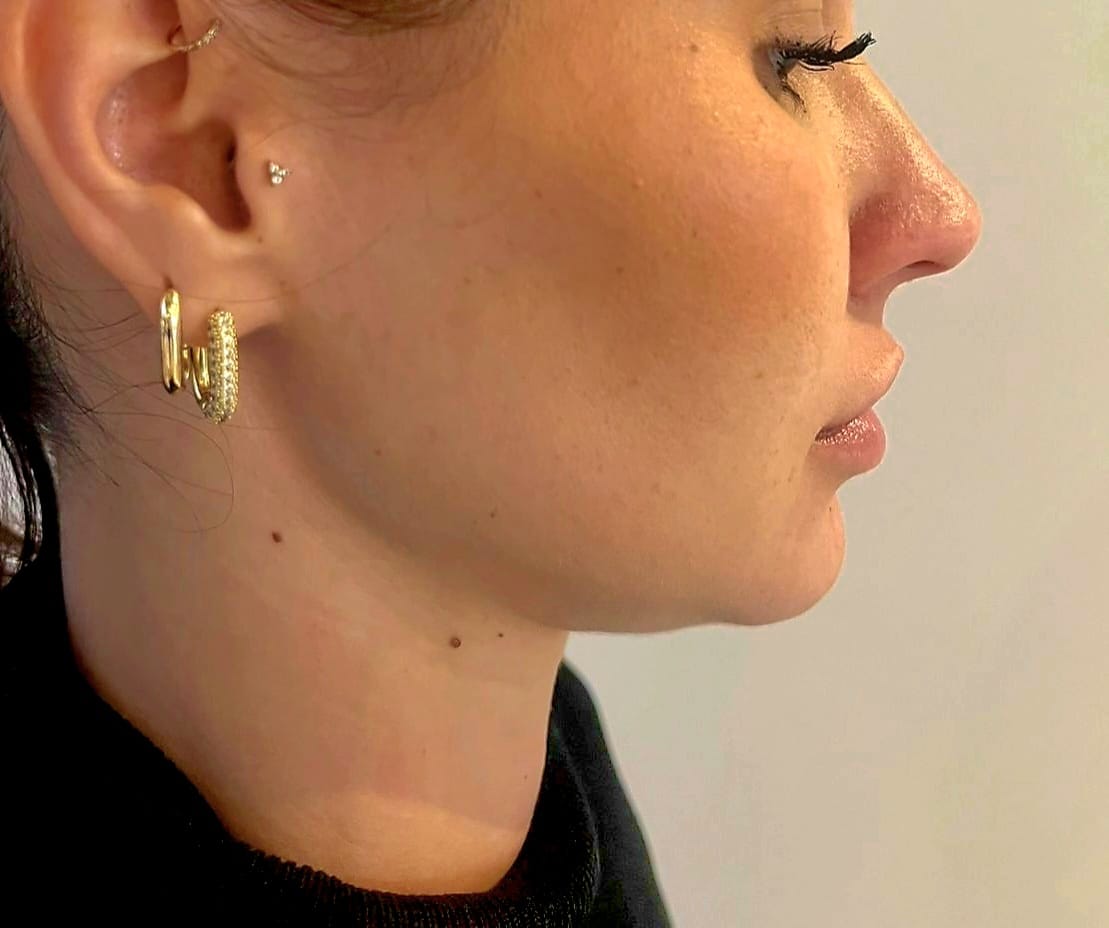 Before HIFU gezicht kaaklijn