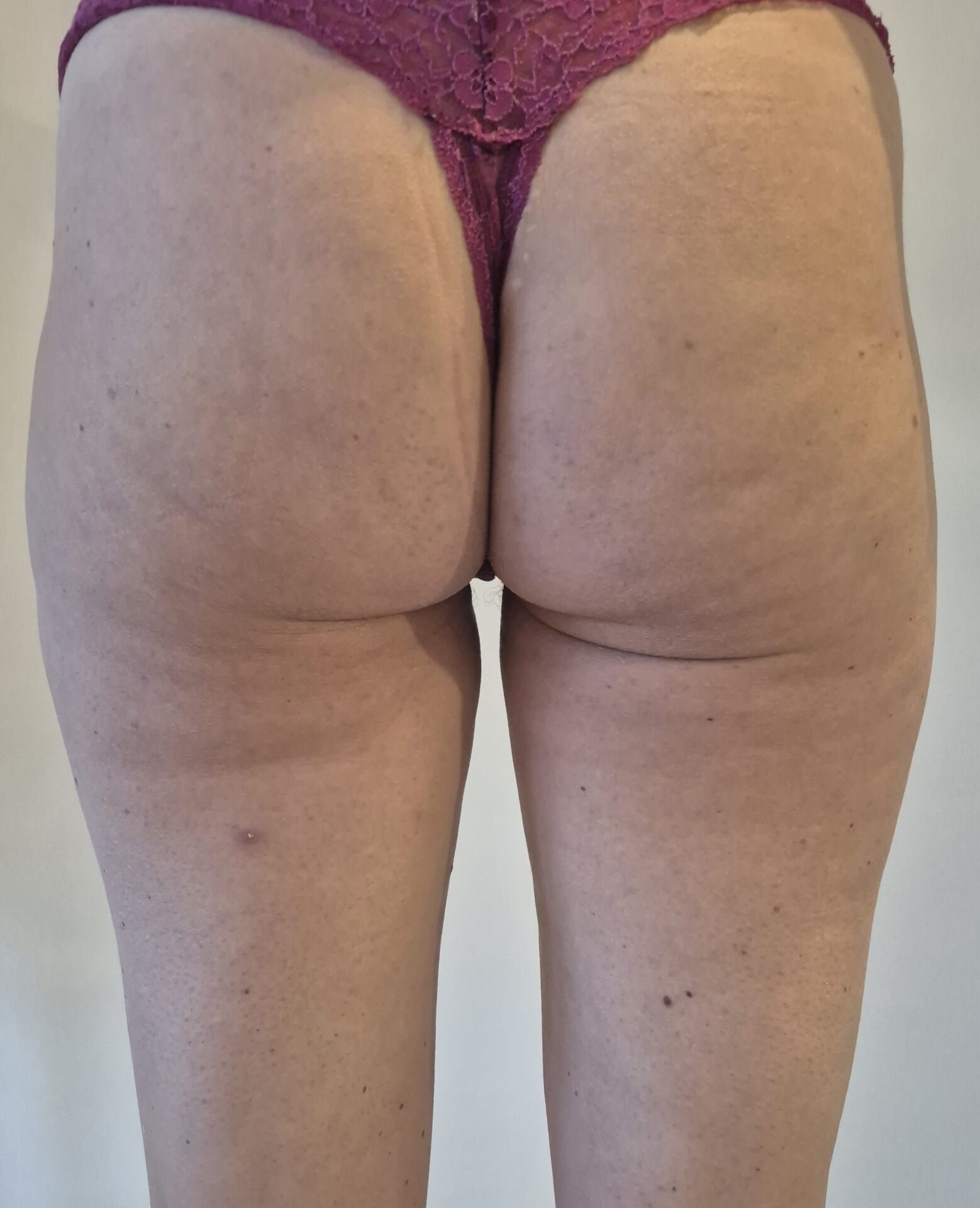 After foto cellulite behandeling