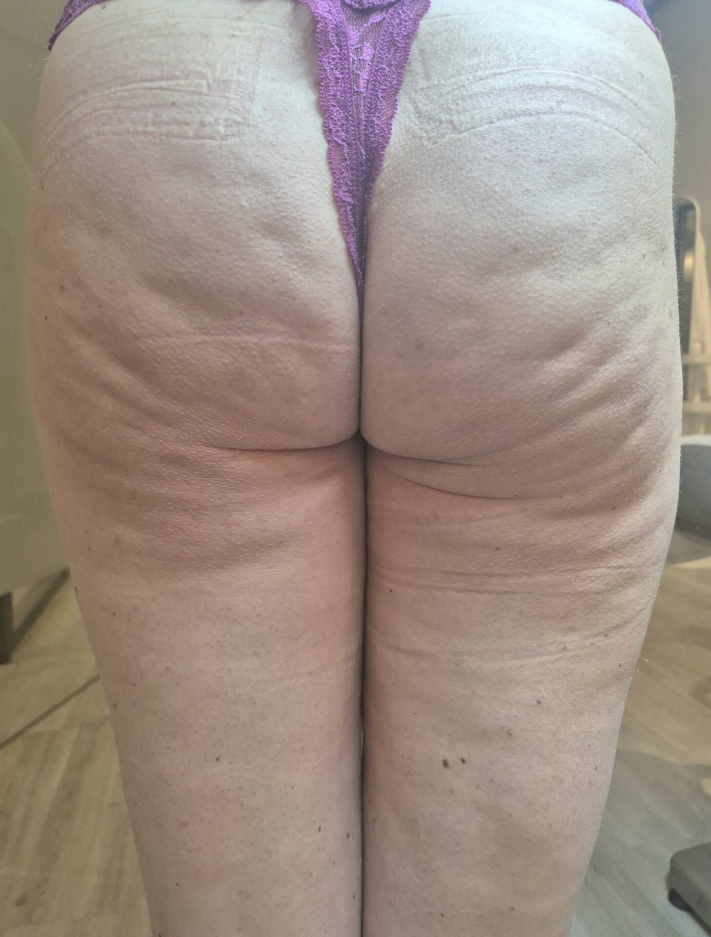 Cellulite behandeling before foto