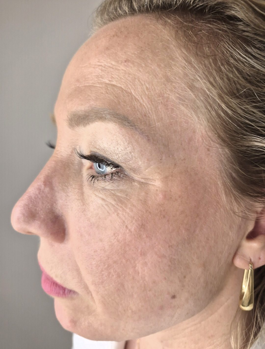Before Liquid Facelift