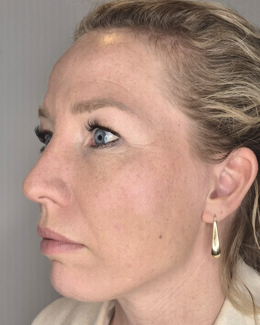 After liquid facelift