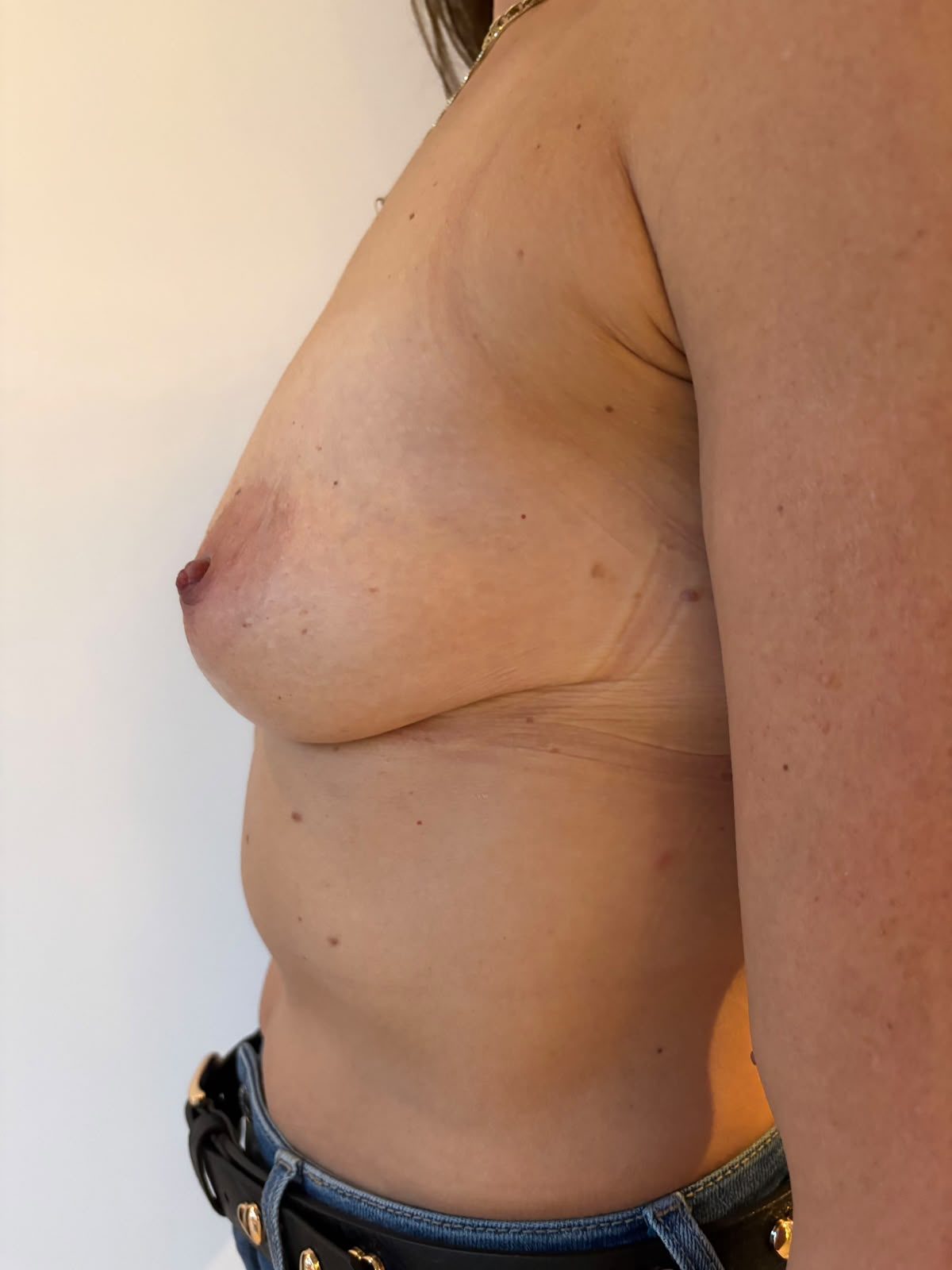 After borstlift zonder operatie zijaanzicht