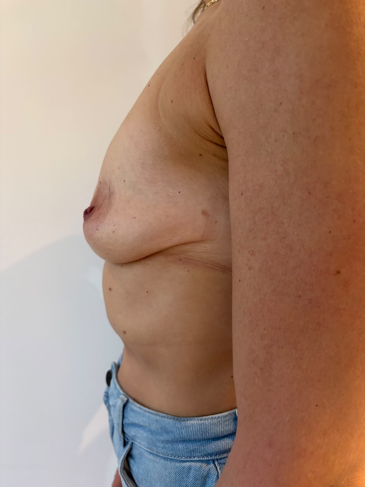 Before borstlift zonder operatie zijaanzicht