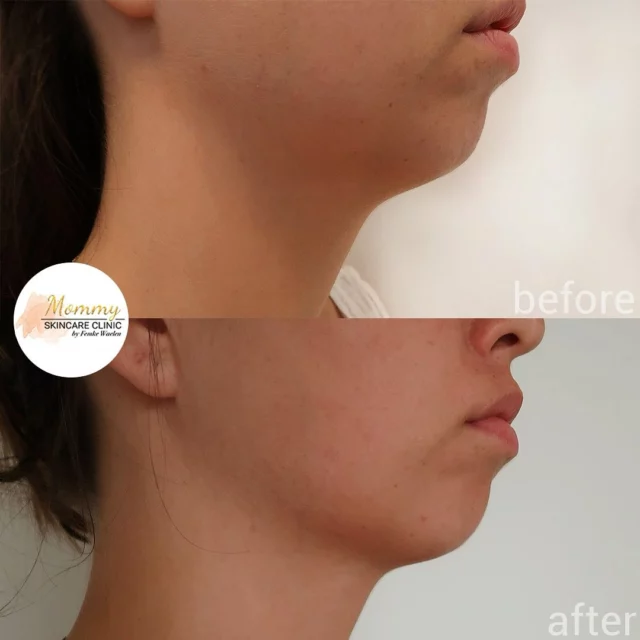 De before & after van de onderkin 🤩

Het resultaat van voorgaande video na slechts 1 behandeling met de HIFU!

#amsterdam #amsterdamijburg #huid #huidtherapie #huidtherapeut #hifu #ultraformer #ultraformer3 #ultraformeriii #onderkin #antiage #skin #clinic #skinclinic #mommy #face