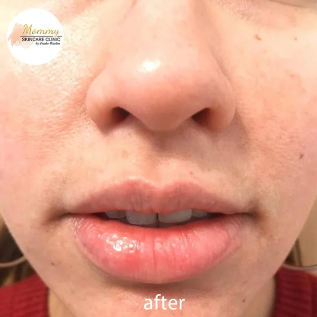 Van zichtbaar pigment naar een stralende, gelijkmatige teint! ✨ 

Deze before & after laat zien wat een doelgerichte aanpak kan doen bij pigment- en melasma-behandelingen. Benieuwd wat we voor jouw huid kunnen betekenen? Neem gerust contact met ons op!

☎️ 020-2101835
📩 info@mommyskincareclinic.nl
⌨️ mommyskincareclinic.nl
📍 Emmy Andriessestraat 504, Amsterdam

#mommy #pigment #peeling #tca #fenol #peelings #melasma #microneedling #clinic #kliniek #huidtherapie #skintherapy #skin #health #healtyskin #skincare