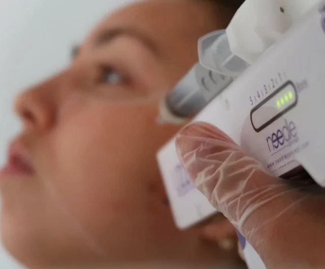Mesotherapie voor het gezicht 💉

Met behulp van de injector wordt een combinatie van verschillende mineralen en vitaminen ingebracht in de huid, waardoor de huid van binnenuit gevoed wordt. Daarmee kunnen wij de huid verbeteren met één of enkele gezichtsbehandelingen.

#u225 #u225injector #meso #mesotherapy #mesotherapie #clinic #kliniek #injector #antiage #antiwrinkle #mommy #amsterdam #amsterdamijburg #huidtherapie #skin #skintherapist