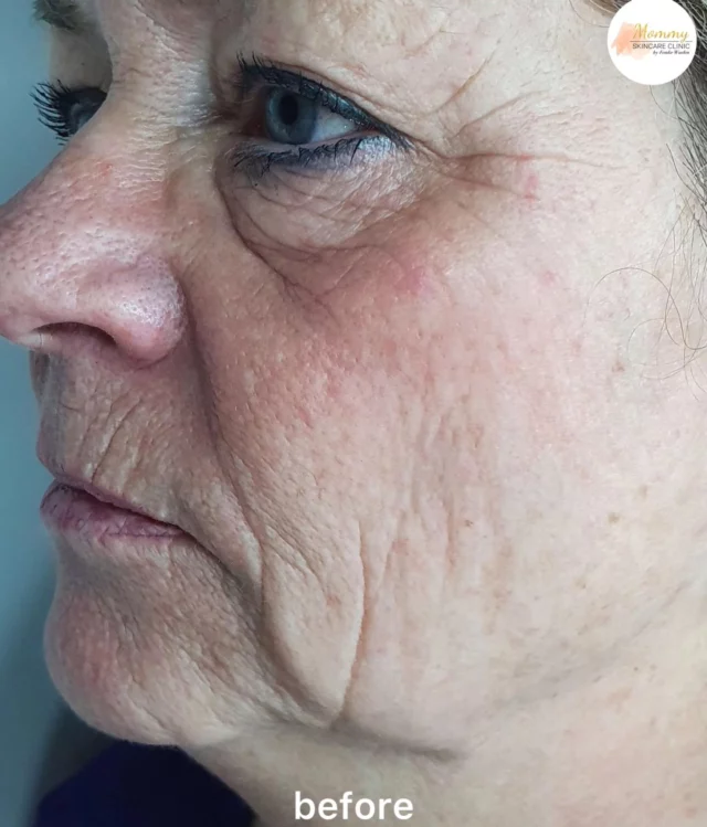 💕 Resultaat na 1 hifu- en mesotherapie behandeling

Wil jij voor de feestdagen je huid nog opknappen maar wil je geen herstel? Dan hebben wij de perfecte behandeling voor je. Deze dame had s'avonds een feestje, wij hebben haar einde van de dag behandeld met onze Hifu en gelijk daarna de huid opgefrist en geboost met de mesotherapie behandeling waarbij we ook volume hebben gecreëerd in haar wangen. 

Het resultaat is direct na de behandeling vastgelegd. 
Het meer definitieve resultaat is na 8-12 weken zichtbaar. 

Dus wil je er op en top uitzien met de feestdagen zonder herstel, boek dan bij ons een consult en of behandeling in. 

Www.mommyskincareclinic.nl 
Info@mommyskincareclinic.nl 
020-210 1835

#hifubehandeling #hifutreatment #ultraformer3 #ultraformer #skinresurfacing #antiaging #antiagingtreatment #mesotherapy #filler #skintightening #facial #beautytreatment #beauty #cosmeticclinic #skintherapist #huidtherapeut #huidverjonging #ulthera #amsterdamijburg #amsterdam #beforeafterhifu #beforeafter