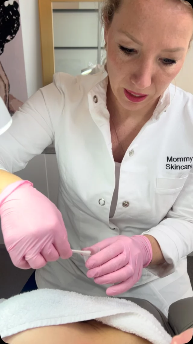 Peeling-seizoen! In de winter kunnen we goed aan onze huid werken en dat kan uitermate goed met peelings. Wij behandelen niet alleen het gezicht, maar ook bijvoorbeeld de decolleté. Ideaal voor het behandelen van lijntjes en pigmentatie op het decolleté. 

☎️ 020-2101835
📩 info@mommyskincareclinic.nl
⌨️ mommyskincareclinic.nl
📍 Emmy Andriessestraat 504, Amsterdam

#mommy #skin #skincare #clinic #huidtherapeut #huidtherapie #ijburg #amsterdam #amsterdamijburg #kliniek #huid #huidverbetering #antiageing #peeling #tca #skinrejuvenation #skintreatment #cosmeticclinic #beautytreatments #treatment #facial