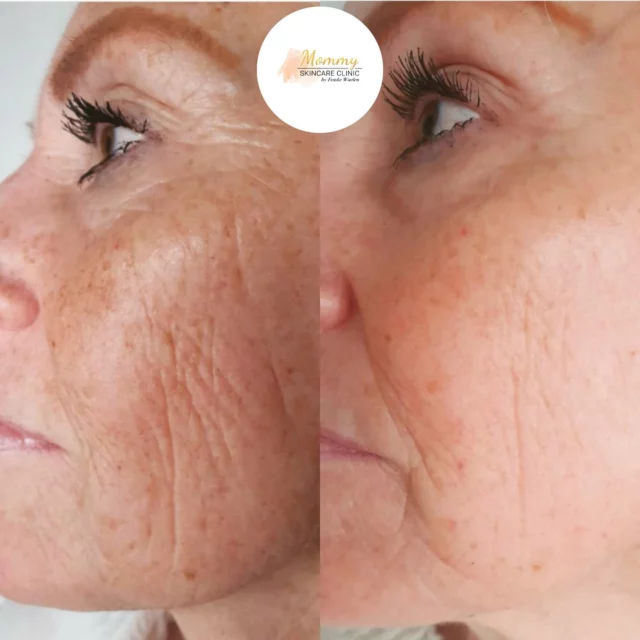Het resultaat na 1 hifu behandeling 💫
Wil je zonder herstel een behandeling voor de feestdagen? Dat kan met onze hifu behandeling! Gegarandeerd succes!
 
Boek een consult bij een van onze huidtherapeuten:

☎️ 020-2101835
📩 info@mommyskincareclinic.nl
⌨️ mommyskincareclinic.nl
📍 Emmy Andriessestraat 504, Amsterdam

#mommy #skin #skincare #clinic #huidtherapeut #huidtherapie #ijburg #amsterdam #amsterdamijburg #kliniek #huid #huidverbetering #antiageing #ultraformer #hifu #ultraformer3 #huidverstrakking #skinrejuvenation #ulthera #ultherapy #facial #skintreatment #treatment