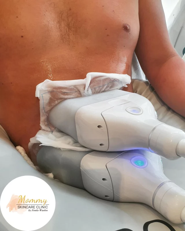 Bevriezen van vet doen we door middel van Cryolipolyse. ❄️

Hier hebben we gefocust op de buik en extra intensief met 2 koppen behandeld.

☎️ 020-2101835
📩 info@mommyskincareclinic.nl
⌨️ mommyskincareclinic.nl
📍 Emmy Andriessestraat 504, Amsterdam

#mommy #skin #skincare #clinic #huidtherapeut #huidtherapie #ijburg #amsterdam #amsterdamijburg #kliniek #huid #huidverbetering #antiageing #cryo #cryolipolysis #cryolipolyse #fat #fatfreeze #fatfree #body #clatuualpha #clatuu