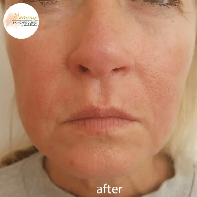 Het resultaat na 1 hifu behandeling 💫
Wil je zonder herstel een behandeling voor de feestdagen? Dat kan met onze hifu behandeling! Gegarandeerd succes!
 
Boek een consult bij een van onze huidtherapeuten:

☎️ 020-2101835
📩 info@mommyskincareclinic.nl
⌨️ mommyskincareclinic.nl
📍 Emmy Andriessestraat 504, Amsterdam

#mommy #skin #skincare #clinic #huidtherapeut #huidtherapie #ijburg #amsterdam #amsterdamijburg #kliniek #huid #huidverbetering #antiageing #ultraformer #hifu #ultraformer3 #huidverstrakking #skinrejuvenation #ulthera #ultherapy #facial #skintreatment #treatment